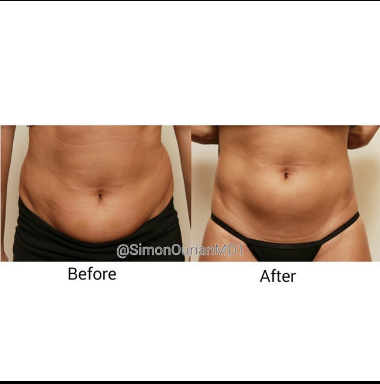 Road To A Desirable Physique Understanding Non Surgical Liposuction