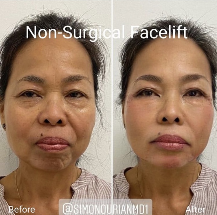 Non Surgical Face Lift Before And After