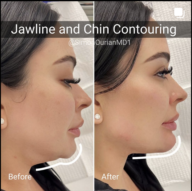 The Complete Guide to Non-Surgical Jawline Contouring