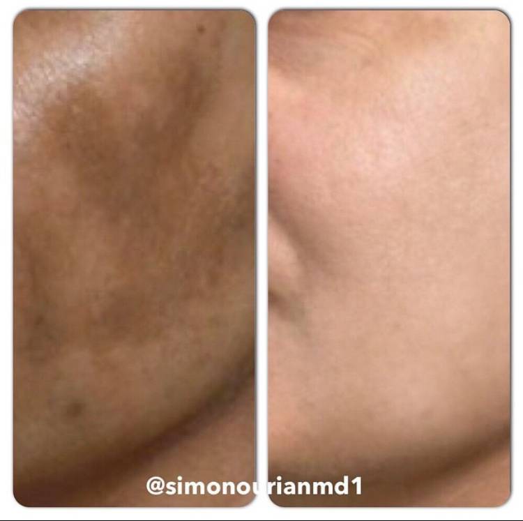 Exploring beneath the surface: Solutions for Melasma on your arms | Epione