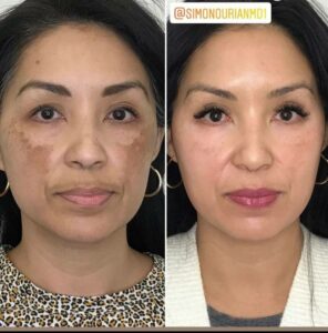 before and after melasma coolaser treatment patient