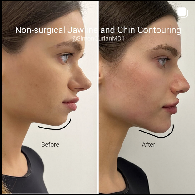 Sculpting the jawline Double chin reduction with radio frequency Epione