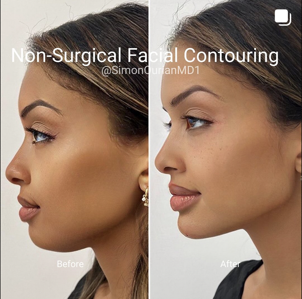 Jawline Filler for a More Sculpted Face