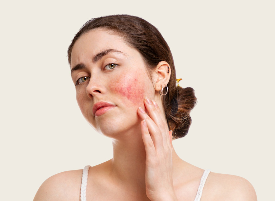 rosacea treatment