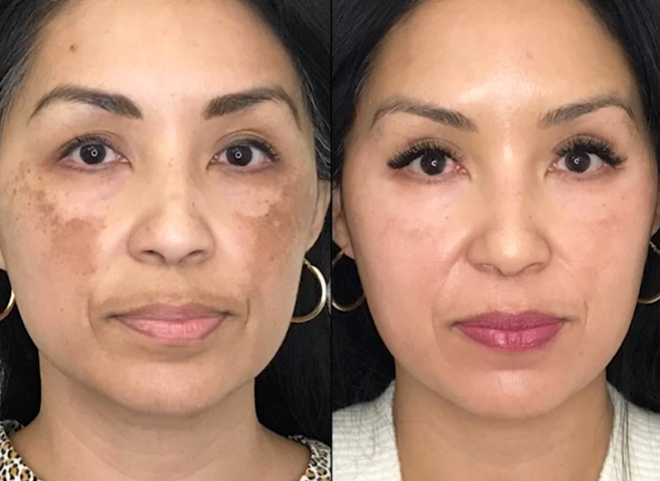 age-spots-removal