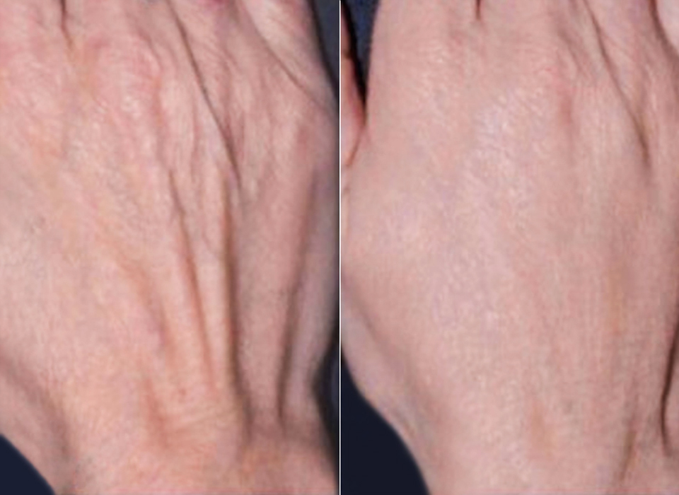 Hand Rejuvenation Image