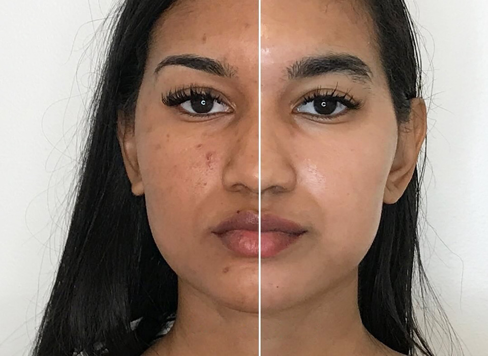 skin-resurfacing