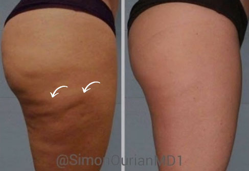 Cellulite before and after