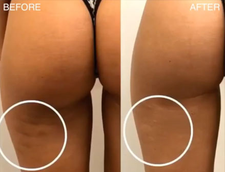 Cellulite before and after